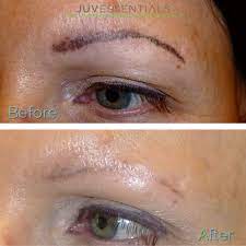 It is a natural way to remove cosmetic and conventional tattoos or to lighten existing pigment. Unlike With Laser Tattoo Removal Any Facial Cosmetic Tattoo Like Microblading For Example Can Be Safely Eyebrow Tattoo Removal Cosmetic Tattoo Brow Tattoo