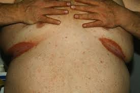 Image result for Erythrasma