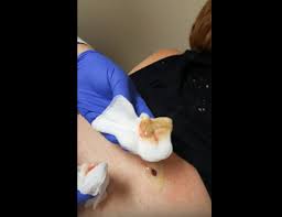 When boils are large, complications can occur that could be harmful to your health. How To Treat A Popped Boil That Hasn T Completely Drained New Pimple Popping Videos