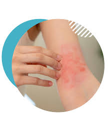 Image result for Atopic eczema atopic dermatitis