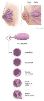 So here's what i learned the last few years — get ready for the breast knowledge you didn't know you need. Breast Cancer Atypical Ductal And Lobular Hyperplasia