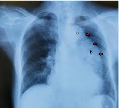 Image result for Cardiovascular Syphilis