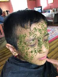 Adakah gejala / simptom resdung ini sering menganggu aktiviti seharian lalu menyebabkan anda rasa tidak selesa? Sapu Air Perahan Limau Tepek Hirisan Daun Pandan Di Muka Petua Tradisional Untuk Sakit Resdung Kronik Mingguan Wanita