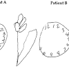 Schenkenberg line bisection task in metrisquare diagnoseis. 1