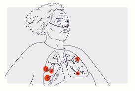 Image result for Emphysema