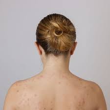 Bacne Das Hilft Gegen Pickel Am Rucken Wienerin Tratamento De Acne Tratamento Natural De Acne Acne Cistica