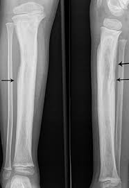 Image result for Osteomyelitis