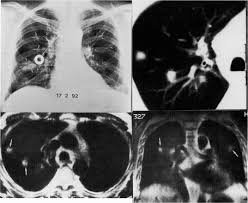 The mold that triggers the illnesses, aspergillus, is everywhere — indoors and outdoors. Invasive Pulmonary Aspergillosis Chest
