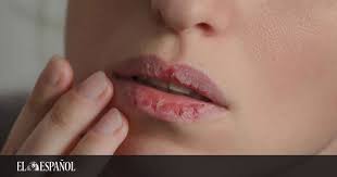 Como Reparar Labios Agrietados Por El Frio Con Remedios Caseros
