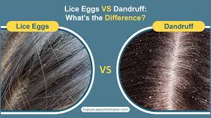 Image result for lice vs nits
