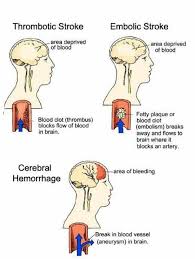 Pin By Tiffani Wallace Dysphagia Ramb On Medical A Nurse Medical Knowledge Stroke Nursing Nursing Information Med Surg Nursing