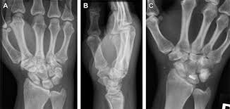 Image result for Scapholunate Dislocation
