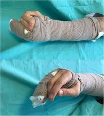 Image result for Ulnar Gutter Splint
