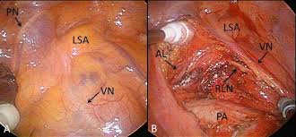 Lobektomie Wikipedia