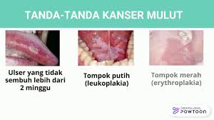 Kanser mulut dan tekak mulut merangkumi sekitar 2% daripada semua kanser yang didiagnosis setiap tahun di a.s. Kanser Mulut Youtube