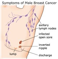 But if you find a lump in your breast, see a doctor as soon as possible. Breast Cancer Symptoms Review Male Breast Cancer Symptoms
