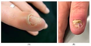 Image result for onychomycosis