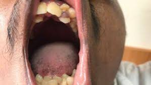 Image result for Canker sores symptoms roof of the mouth