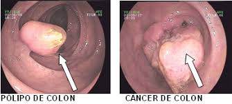 Resultado de imagen para detección del cáncer colorrectal