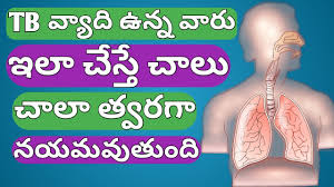Tb In Telugu Tb Treatment In Telugu How To Cure