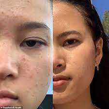 Banish those blemishes and get glowing skin! Student Reveals The Diet And Skincare Regime That Cleared Up Her Embarrassing Acne Using Js Health Newsopener