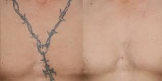 Mar 19, 2021 · how much did you spend on tattoo removal (total)? Laser Tattoo Removal In Dubai Men Women Euromed