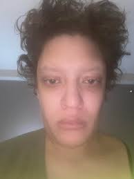 What causes uneven facial features?