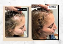 Does too much or too little shampooing cause hair loss? I Tried It Harklinikken The Scandinavian Hair Growth System Everyone S Buzzing About