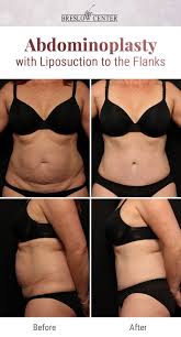 Patient Presented With An Umbilical Hernia After Three Children And Wanted Her Pre Baby Body Back Flank Liposuctio Abdominoplasty Umbilical Hernia Tummy Tucks