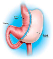 Insurance coverage varies by the insurance provider and state. Sleeve Gastrectomy Surgery At Mercy Weight Management Center In Toledo Ohio