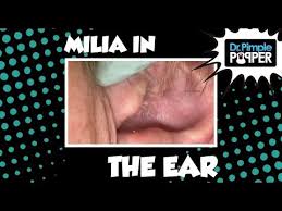 First youtube videos, then a tlc special, and now a primetime series: Most Viral Dr Pimple Popper Videos On Youtube In 2018