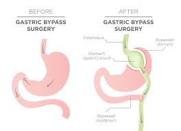 Pin On Gastric Bypass Diet