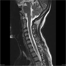 Compression of the upper spinal cord, multiple sclerosis, transverse myelitis, behçet's disease, osteogenesis imperfecta lhermitte phenomenon , also called the barber chair phenomenon , is an uncomfortable electrical sensation that runs through the back and into the limbs. Systemic Lupus Erythematosus Myelitis Radiology Case Radiopaedia Org