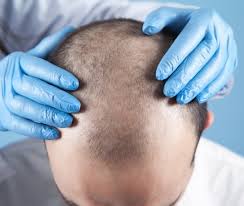 La calvizie colpisce l'80% degli uomini e il 50% delle donne. Trapianto Di Capelli Quanto Costa