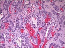 Image result for Glomus tumor
