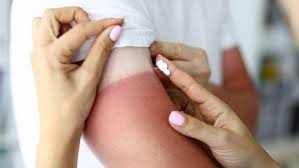 Image result for Sunburn