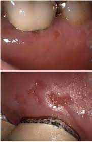 Gingivostomatitis is a combination of gingivitis and stomatitis, or an inflammation of the oral mucosa and gingiva. Herpetic Gingivostomatitis Wikipedia