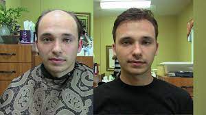 Made from supreme quality natural and synthetic hair, our men's hairpieces for thinning hair are perfect for men who need hair pieces urgently. Non Surgical Hair Replacement Toupee Of Today Youtube