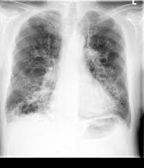 Die chronisch obstruktive lungenerkrankung (copd) ist eine schwere lungenerkrankung, die zwei primäre erkrankungen umfasst. Radiosurf