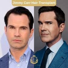Jimmy Carr Saç Ekimi