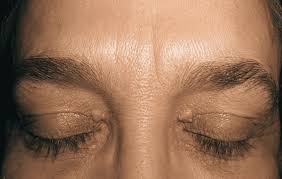 Image result for xantelasma