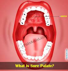 We did not find results for: What Is Sore Palate Or Sores On Roof Of Mouth Sores On Roof Of Mouth Mouth Sores Causes Mouth Sores