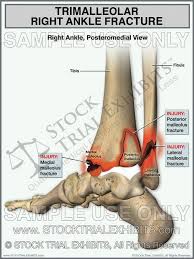 When you break the inner bone of your ankle, it is called a medial malleolus ankle fracture. Trimalleolar Right Ankle Fracture Ankle Fracture Ankle Surgery Medical