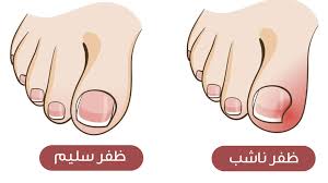‫علاج الظفر الناشب في القدم في تركيا وأهم أسبابه - مركز جواد | Jawad Medical‬‎