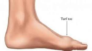 A physician will typically diagnose turf toe based on an athlete's symptoms, sports history, and a physical examination of the injured toe joint. Turf Toe Foot Pain Pti Orthotics Boulder Longmont Colorado