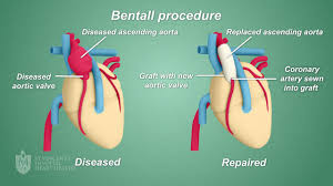 Bentall Procedure St Vincent S Heart Health