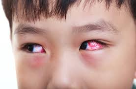 (get up, get up, get up) i better get used to this 'cause it's bloodshot eyes forever can't fool myself from now on it's bloodshot eyes forever for me, for. How To Prevent And Treat Red Eyes In Kids And Babies
