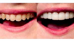Direct veneer (composite veneer), jenis veneer ini menggunakan bahan resin komposit berupa bahan matriks resin yang di. Siapa Sangka Veneer Gigi Bisa Beri Risiko Seumur Hidup Ini Kata Dokter Gigi Tribun Jatim