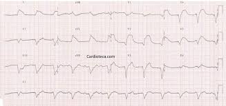 O termo enfarte do miocárdio deve ser usado quando há evidência. Curso Ecg Infarto Agudo De Miocardio En Paciente Que Tiene Un Marcapasos