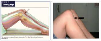 Image result for PCL Sag Test